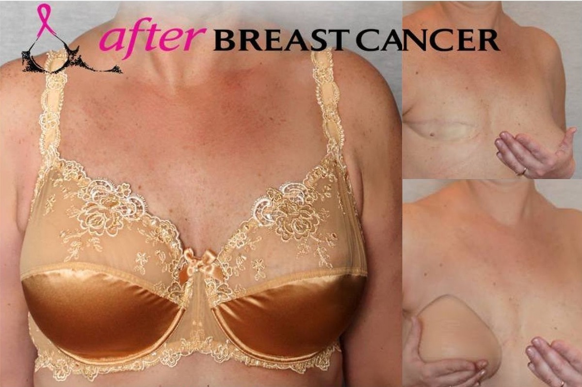 Breast prostheses, bras and clothes after surgery (BCC123)